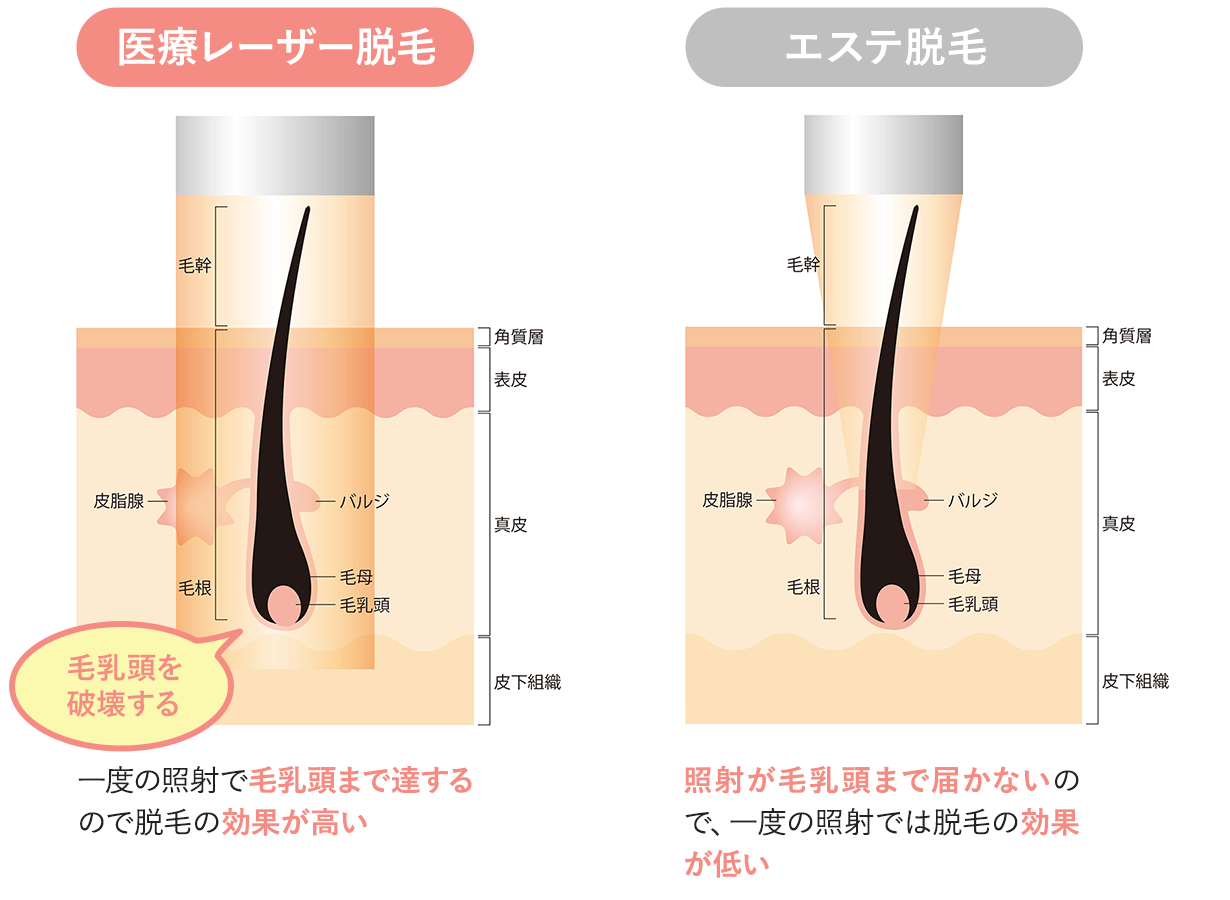 医療レーザー脱毛 エステ脱毛