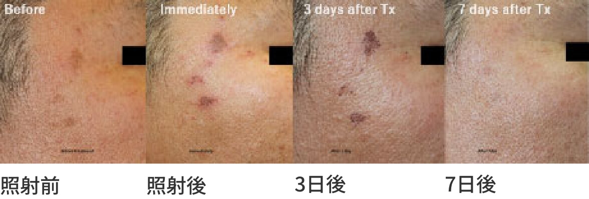 トライビームプレミアムによるシミ治療の経過