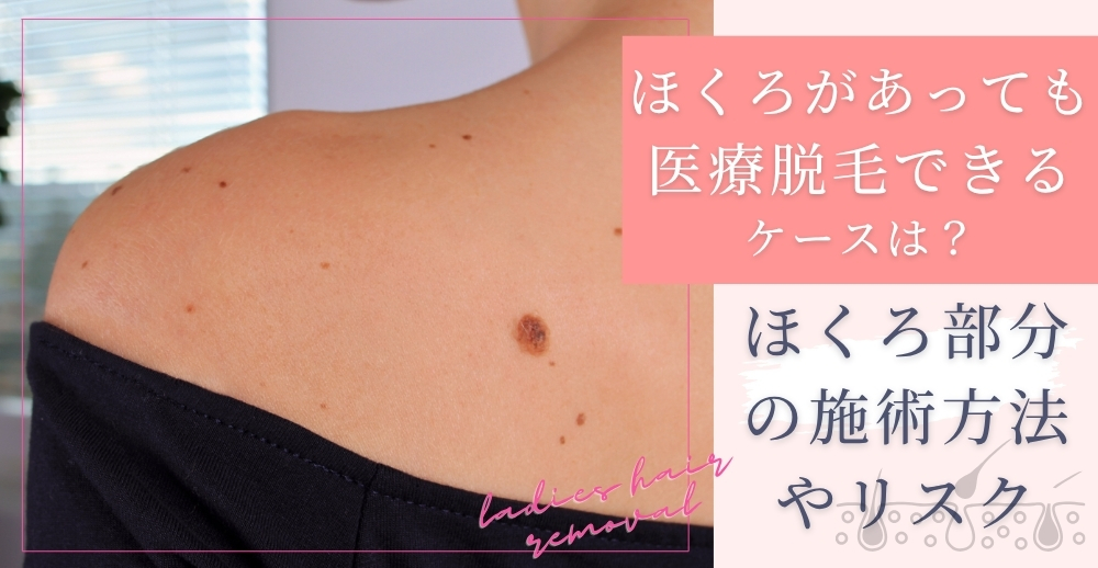 ほくろがあっても医療脱毛できるケースは?ほくろ部分の施術方法やリスクについて解説