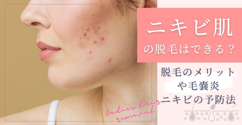 ニキビ肌への脱毛はできる?脱毛のメリットや毛嚢炎、ニキビの予防法について解説