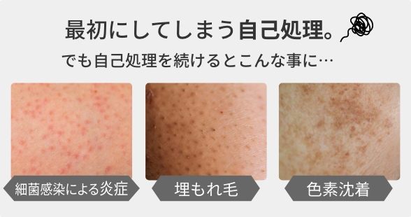 小学生でも脱毛できる？キッズ脱毛の基礎知識と注意点