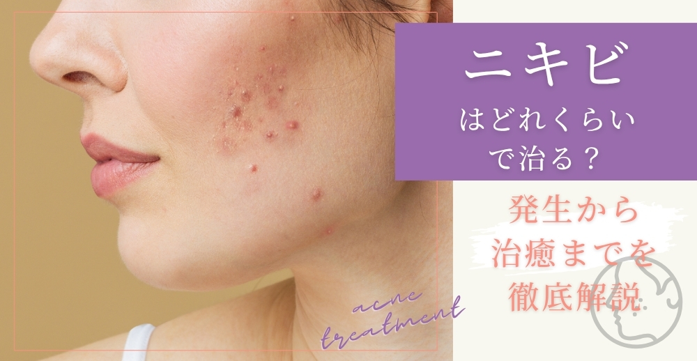 ニキビはどれくらいで治る?発生から治癒までを徹底解説