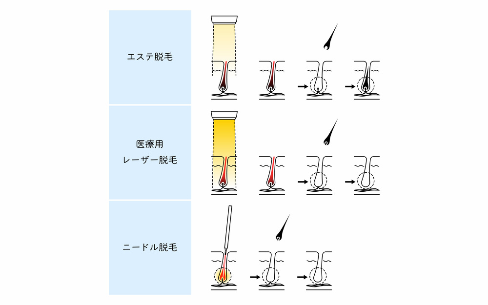 美容脱毛 医療脱毛 違い