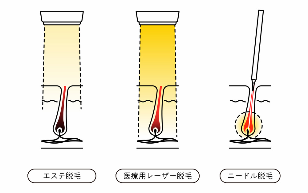 医療 永久脱毛
