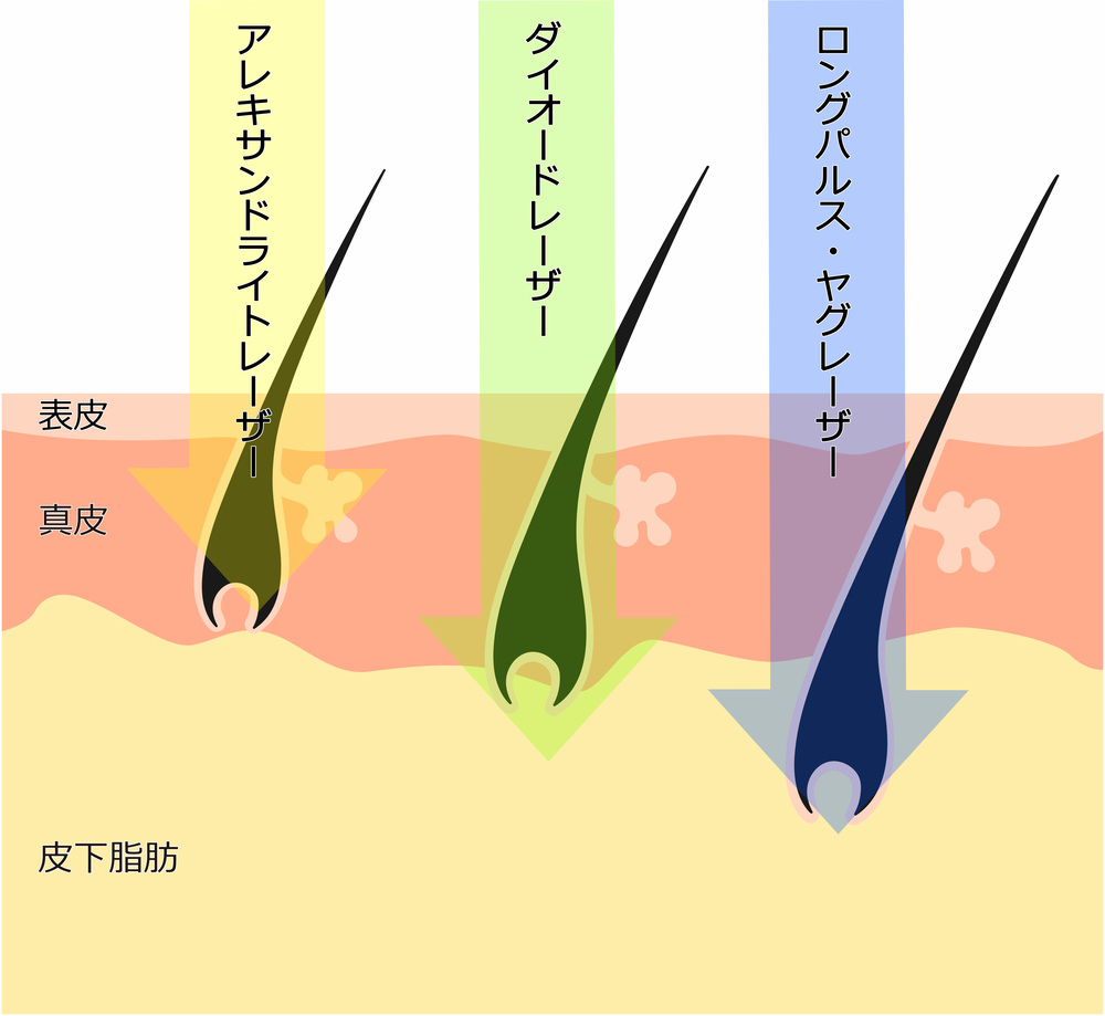 医療脱毛レーザー