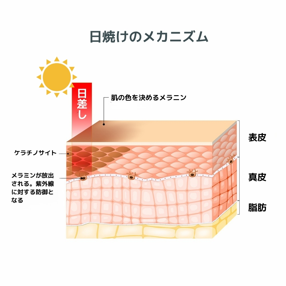 レーザーでシミ取り