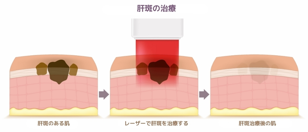 医療レーザー