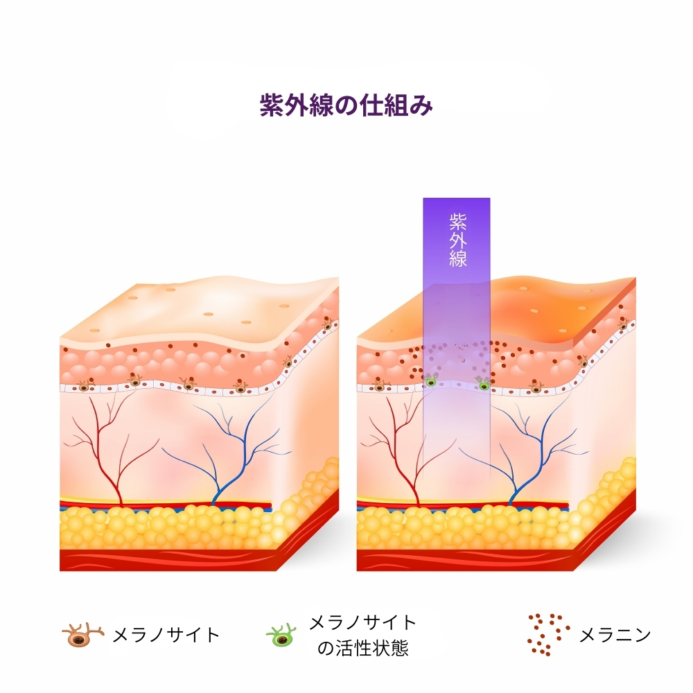 そばかす レーザー 大阪
