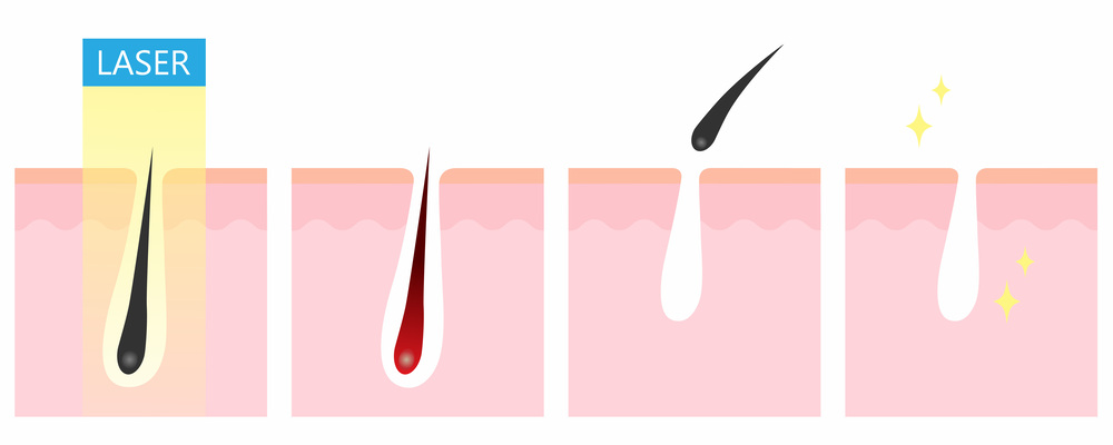 医療脱毛 大阪 効果高い