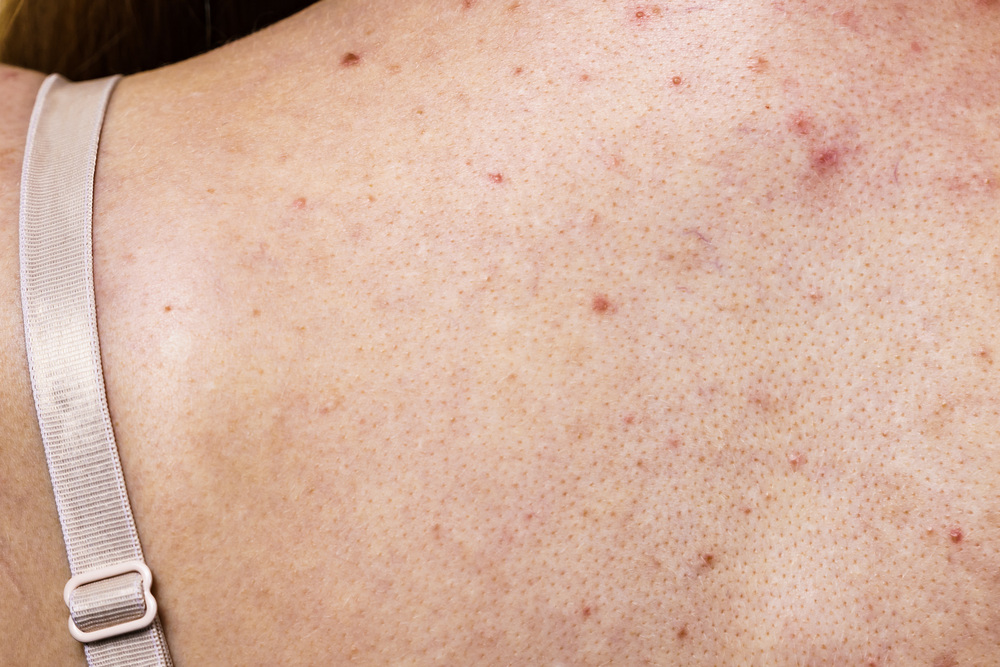 背中 ピーリング 大阪