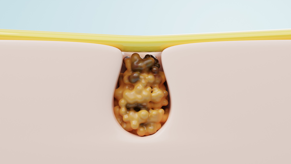 大阪 毛穴 治療