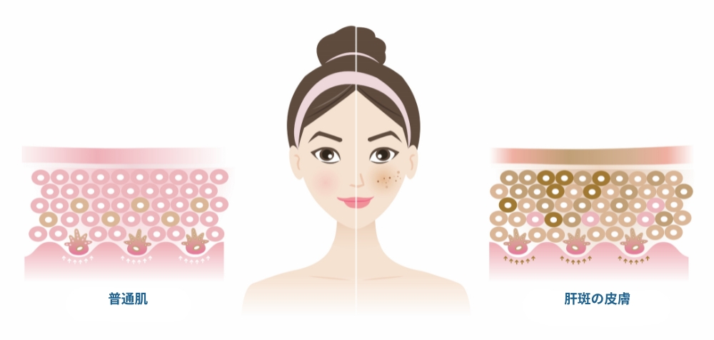 難波 シミ 取り