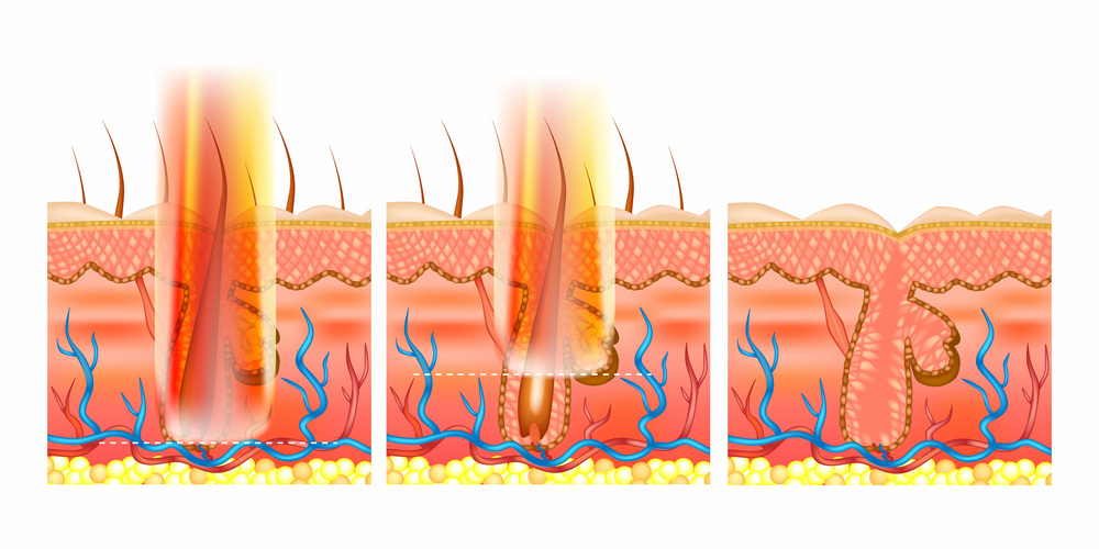 大阪 ヒゲ 脱毛