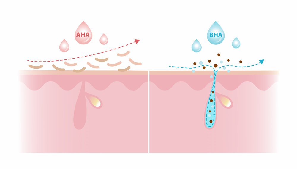 背中 ピーリング 大阪