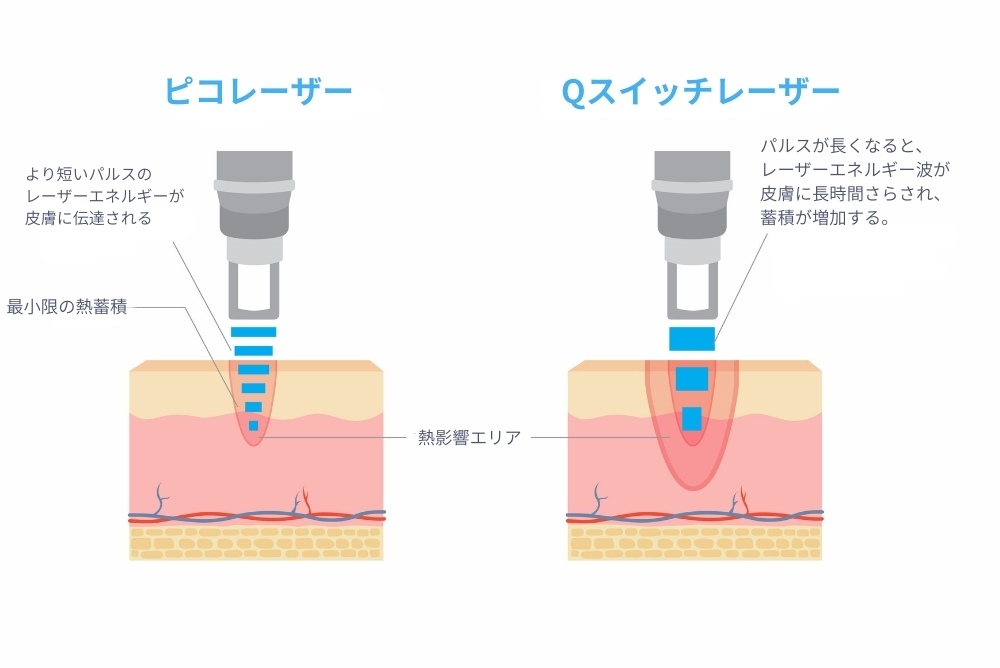 ピコレーザー トーニング 大阪