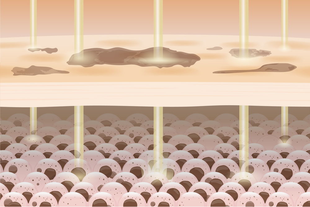 ピコフラクショナルレーザー 大阪 安い