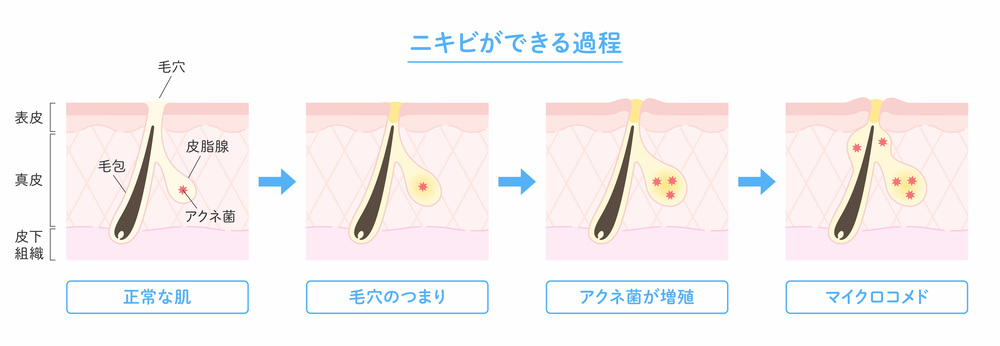 ニキビができる過程のイラスト