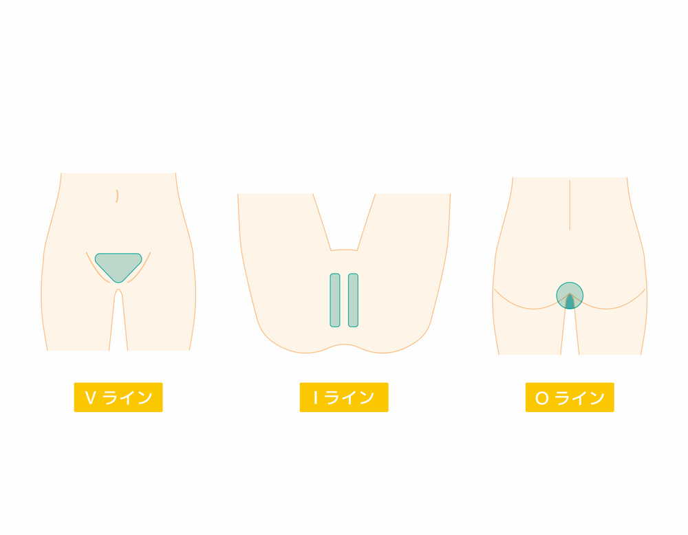 VIOの施術箇所を示すイラスト