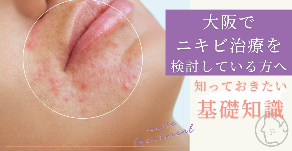 大阪でニキビ治療を検討している方へ：知っておきたい基礎知識