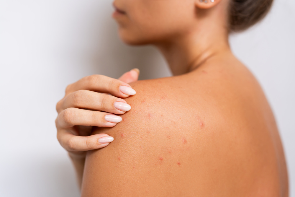 ニキビができた背中