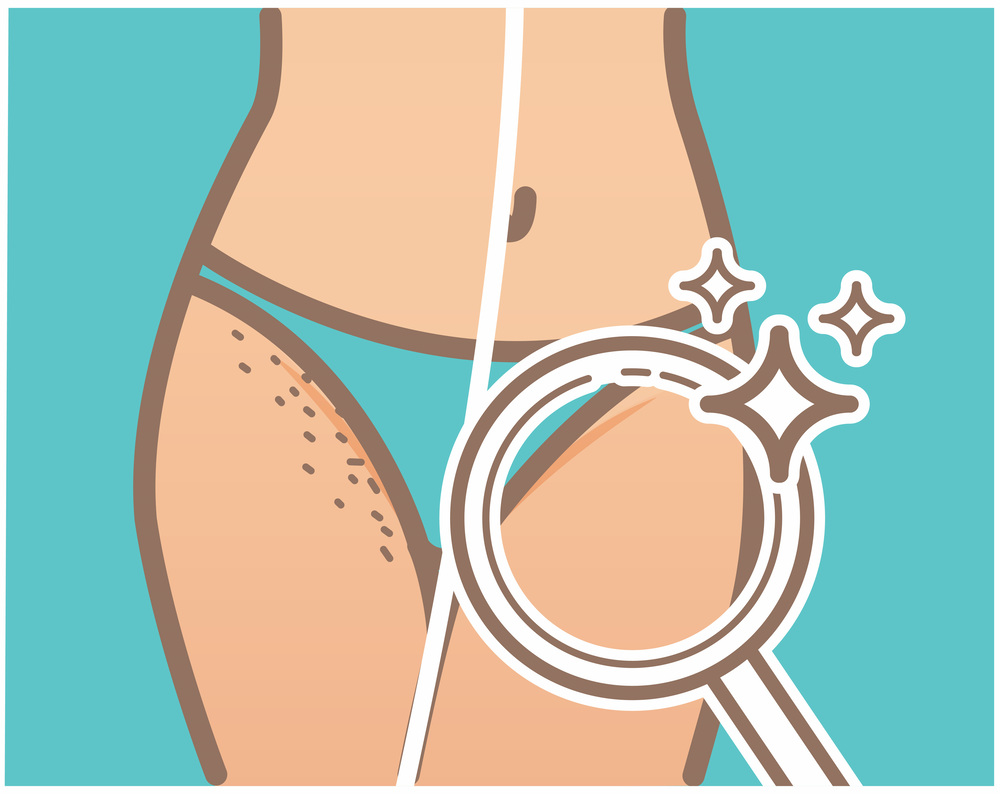 VIO医療脱毛の前後