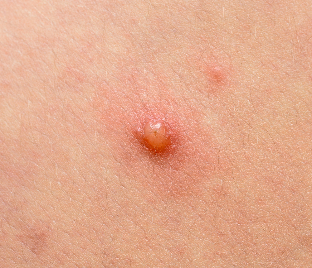 ニキビのアップ