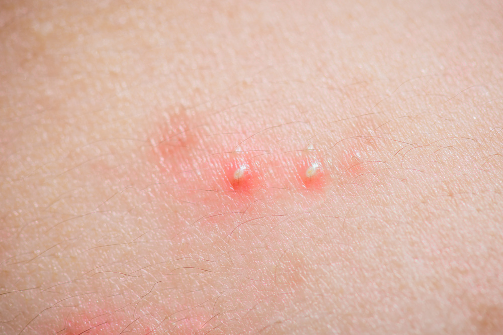 ニキビのアップ