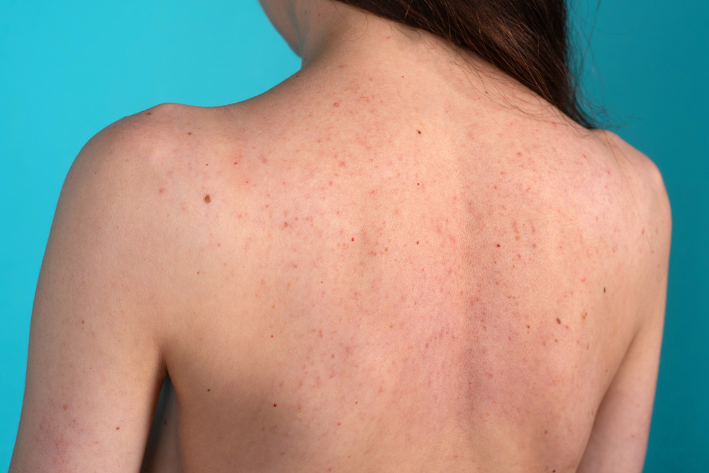 背中にできたニキビ