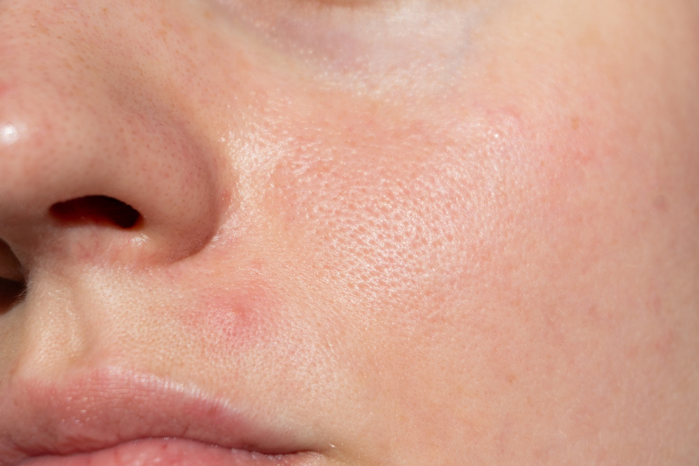 赤み（肌トラブル）が起きた肌