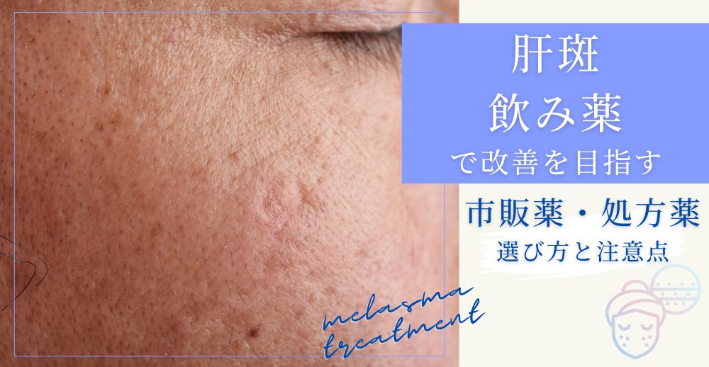 肝斑の飲み薬で改善を目指す：市販薬と処方薬、選び方と注意点