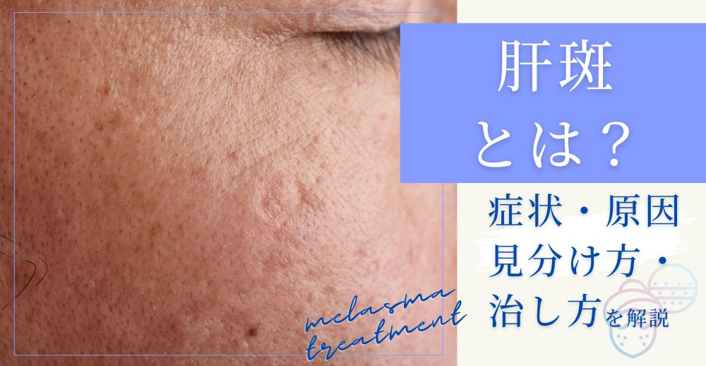 肝斑とは？症状・原因・見分け方・治し方を解説