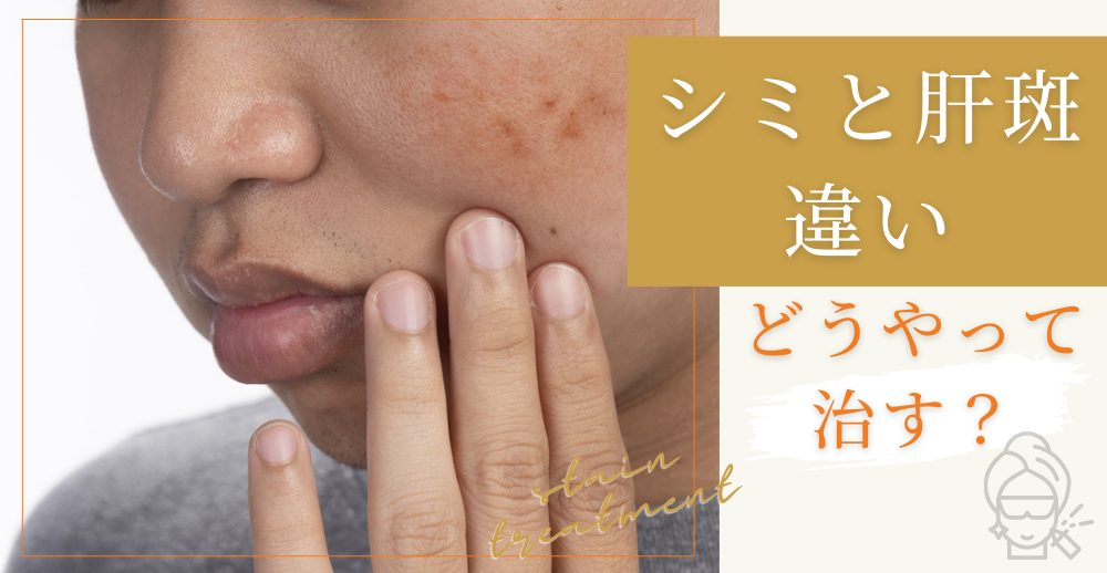 シミと肝斑の違いと治し方