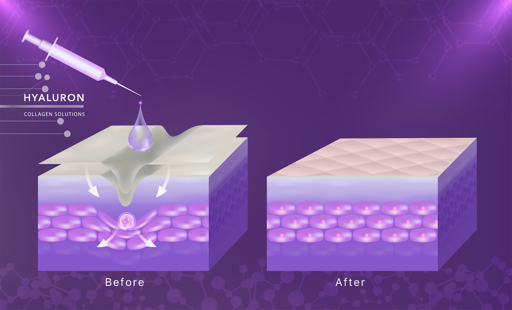 ボトックスのイメージ