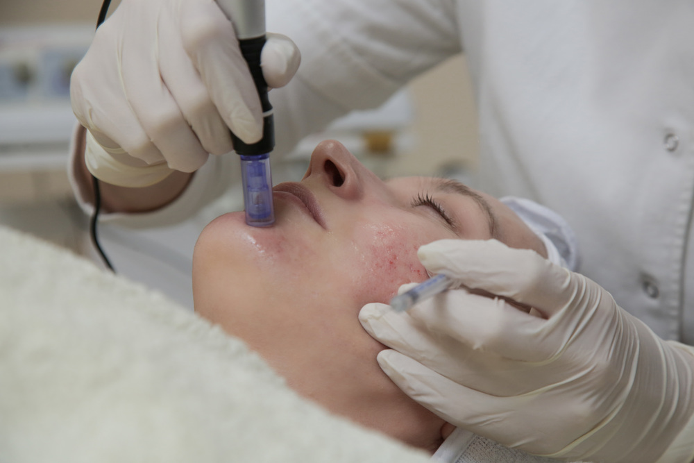 マイクロニードル施術中