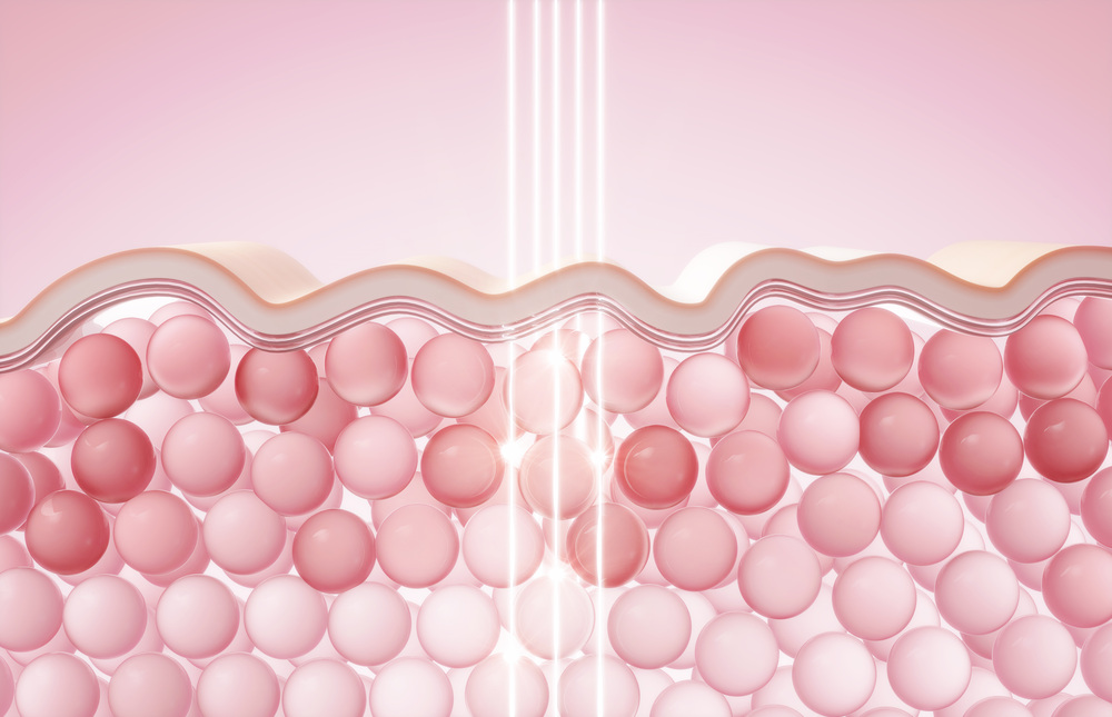 レーザー治療のイメージ