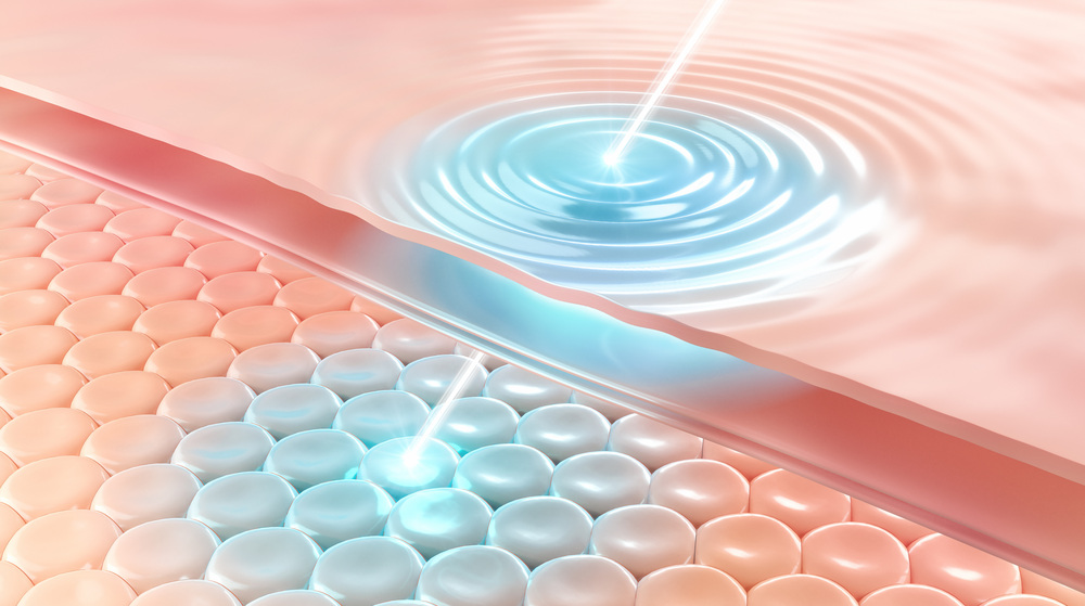 レーザー治療のイメージ