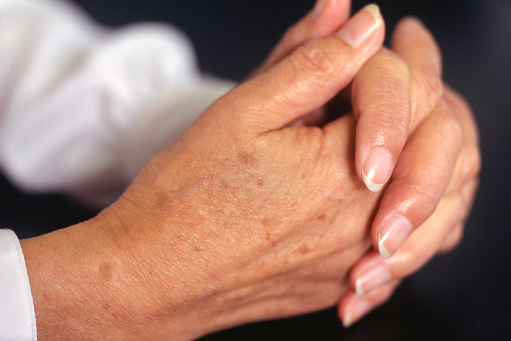 手の甲にできたシミ