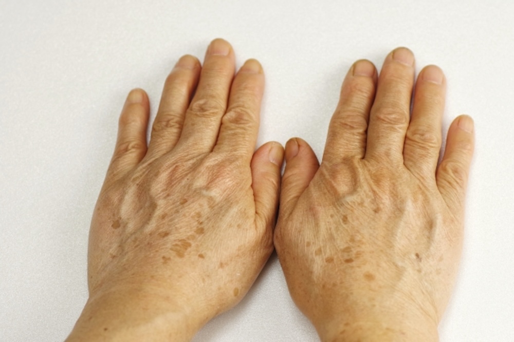 手の甲のシミ
