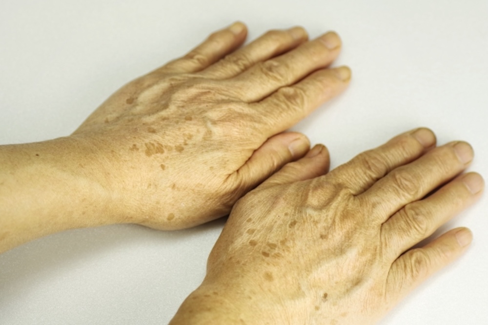 手の甲のシミ