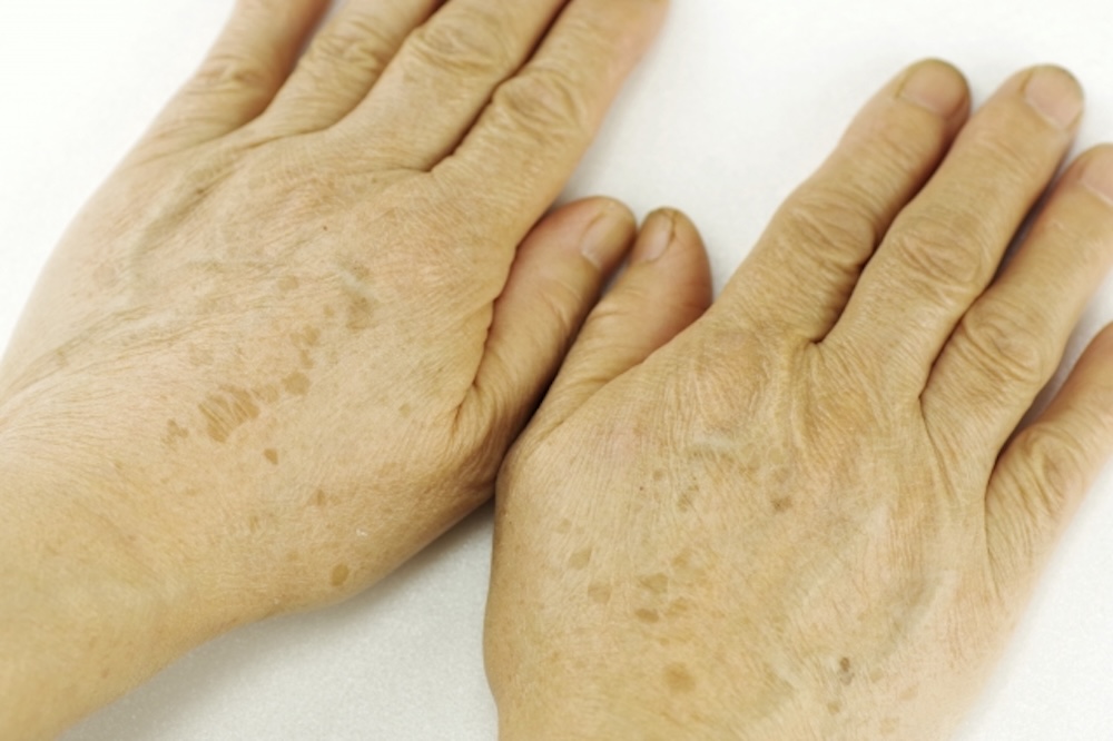 手の甲のシミ