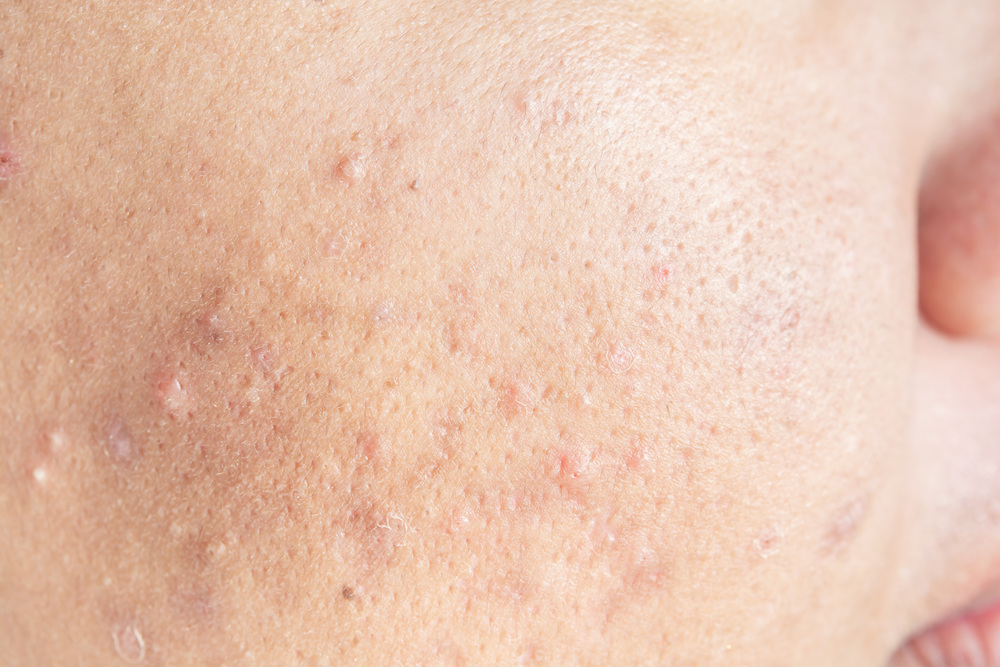 毛穴が目立つ顔