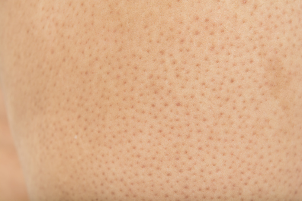 毛穴が詰まった肌