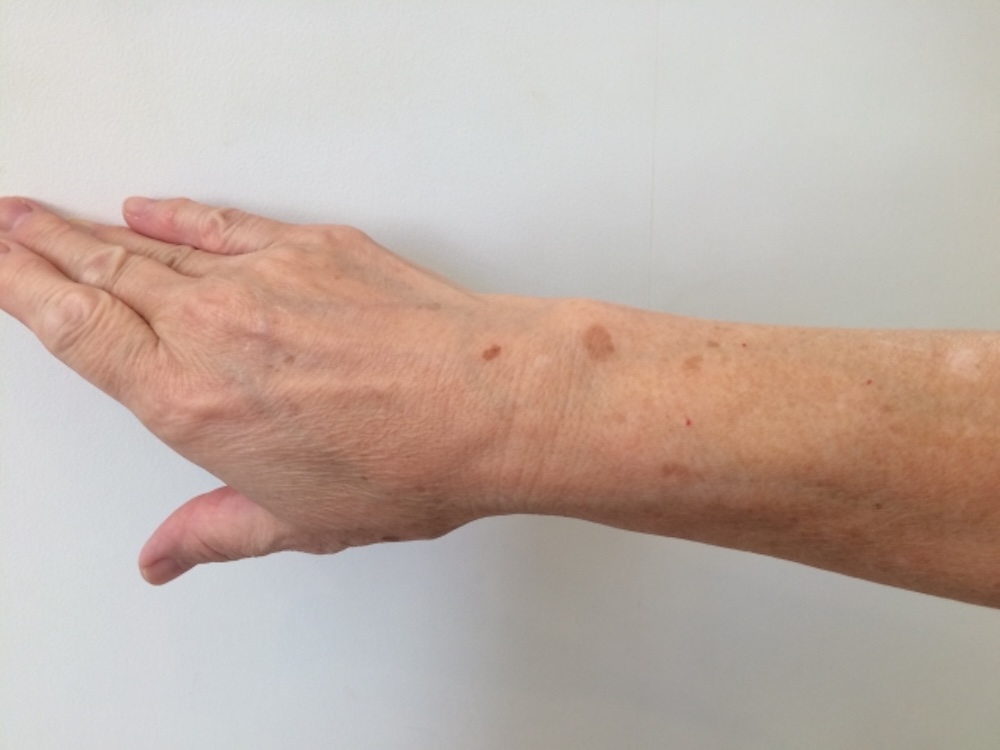 腕にできたシミ