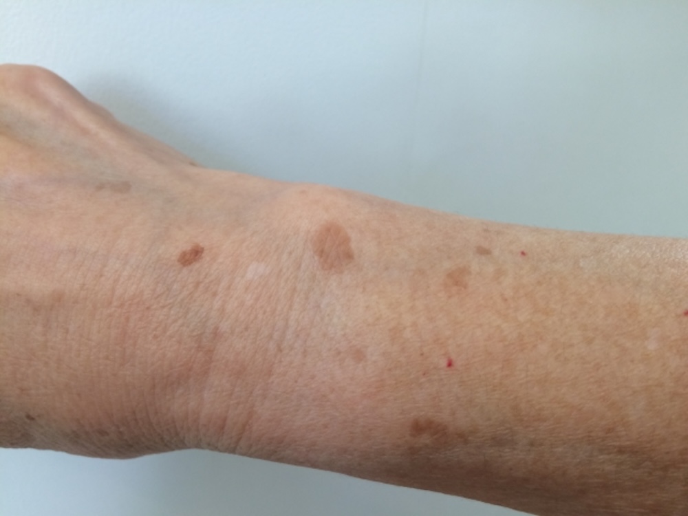 腕にできたシミ