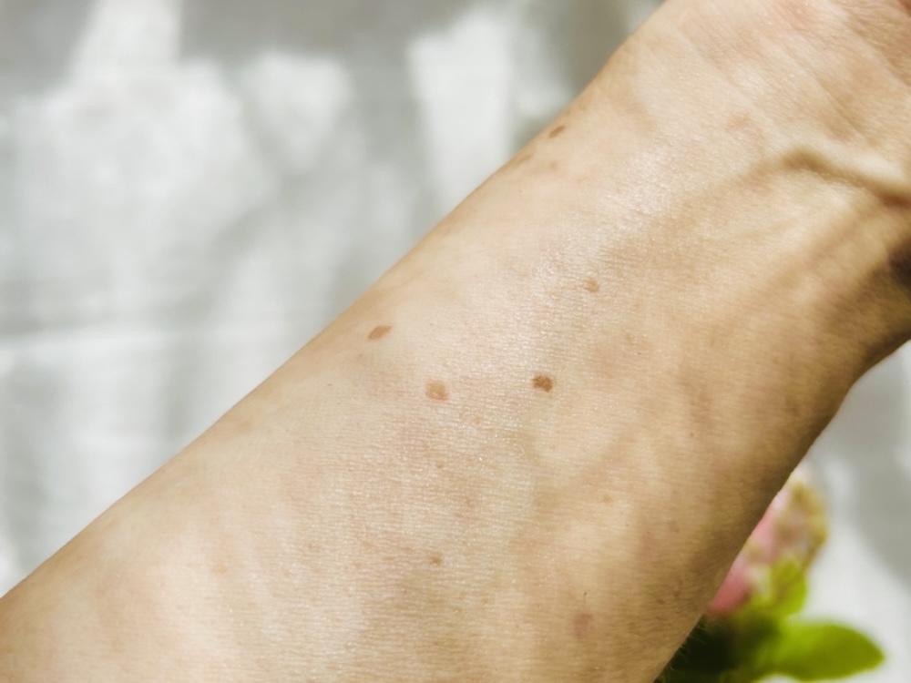 腕にできたシミ