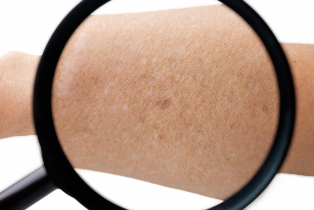 腕にできた肝斑