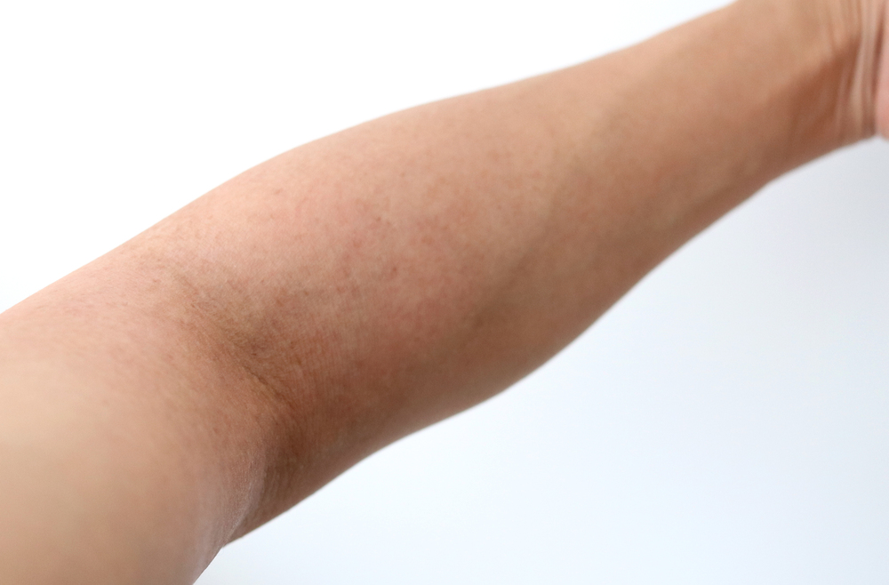 腕の色素沈着