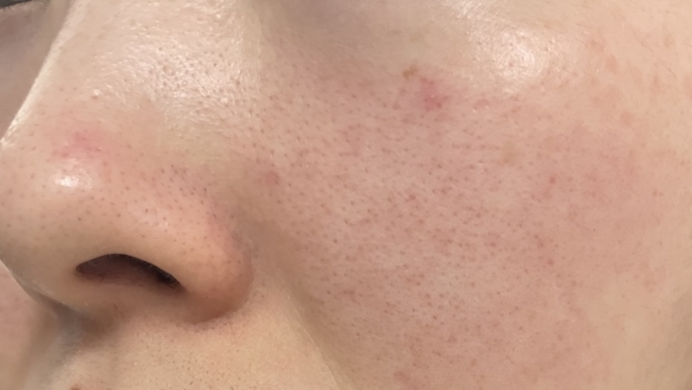 赤ら顔・赤みのある肌