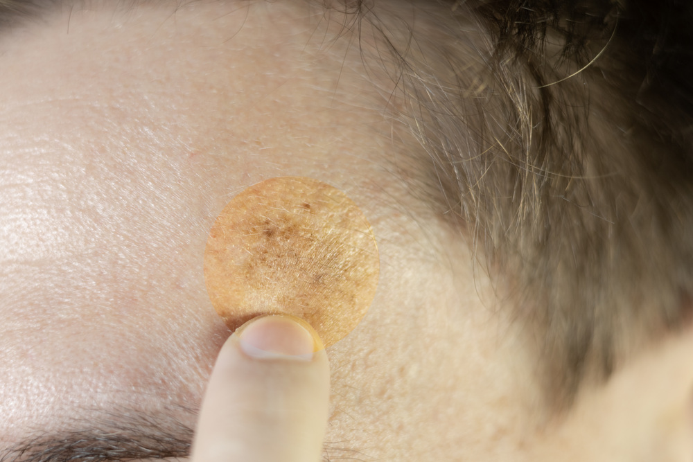 顔にできたシミ