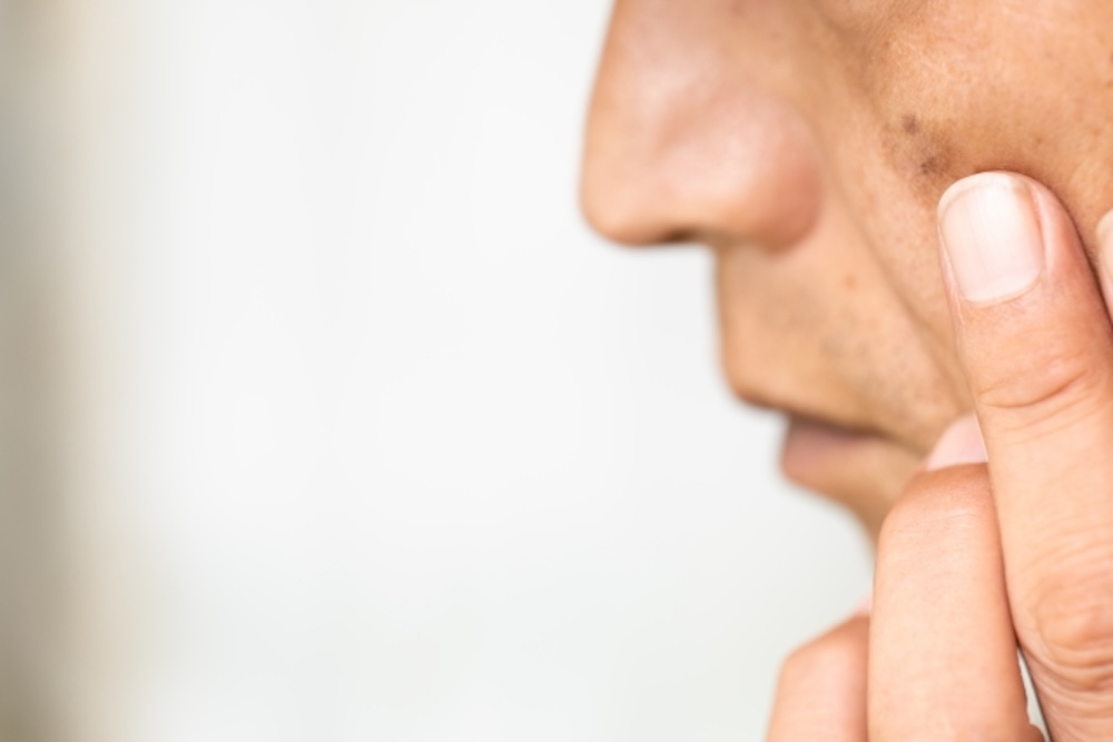 顔にできたシミ